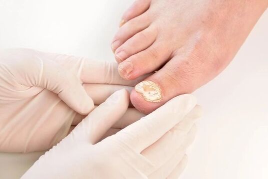 Doctors recommend Fungent for the treatment of athlete's foot