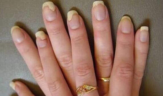 Here's how the nail fungus appears in the exacerbation phase
