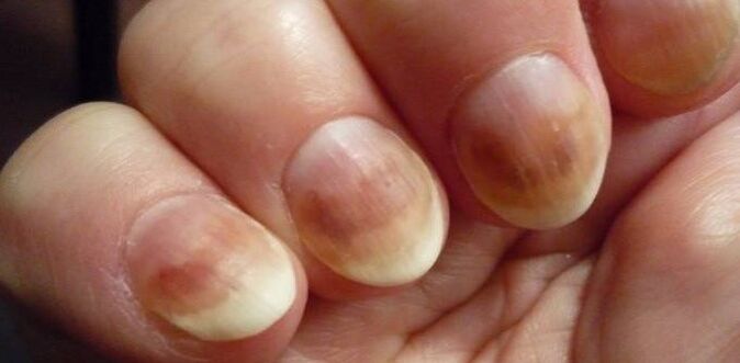 Infection from nail mycosis