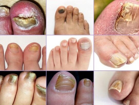 They give nails to various types of mushrooms