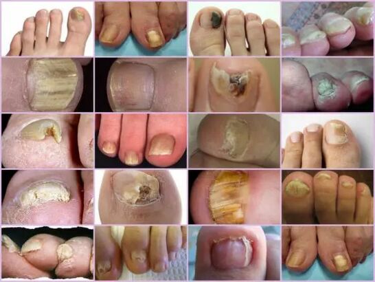 Onychomycosis of various localization on the nail