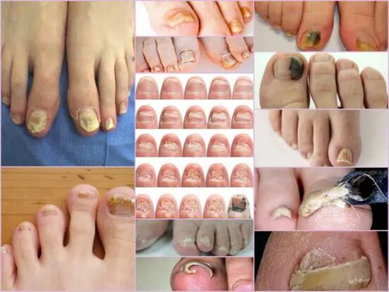 Variety of onychomycosis