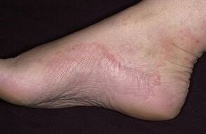 The gun damage to the foot