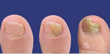 Phase of development of the nail fungus